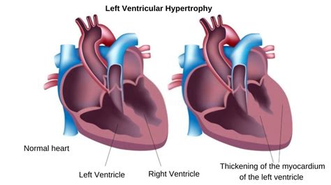 lv heart|living with left ventricular hypertrophy.